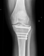 osteotomie Dokter Dujardin Jan orthopedie heup en knie specialist traumatologie operatie nieuwe knie heup prothese meniscus kruisband sportgeneeskunde izegem hechting kraakbeen operatie chirurg heelkunde arthrose arthritis pijn petré defoort vandendriessche knieprothese heupprothese topdokter arts kunstknie topdokters beste kunstheup topchirurg